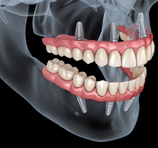 Illustration of All-on-4 for upper and lower dental arches