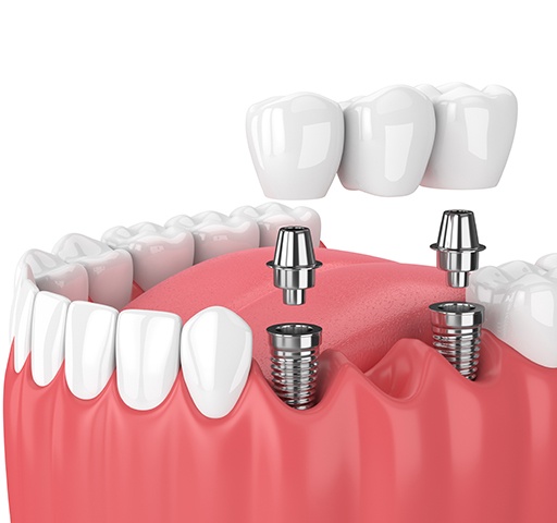 Illustration of traditional implant bridge