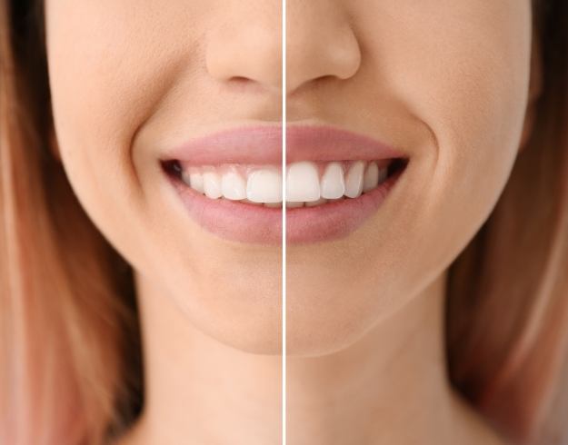 Womans smile before and after gum recontouring