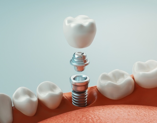 Illustration of single dental implant and crown in lower arch