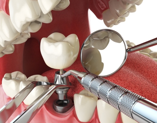 Illustration of abutment and crown being attached to dental implant