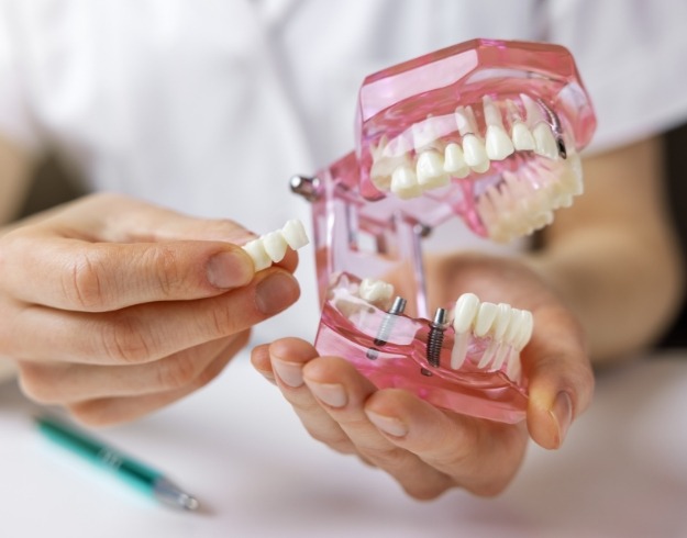 Holding model of mouth with dental implant and a separate dental bridge