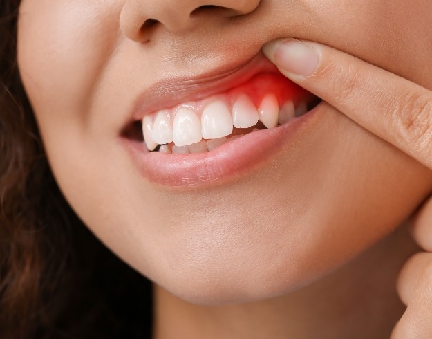 Woman holding up lip to show inflamed gums