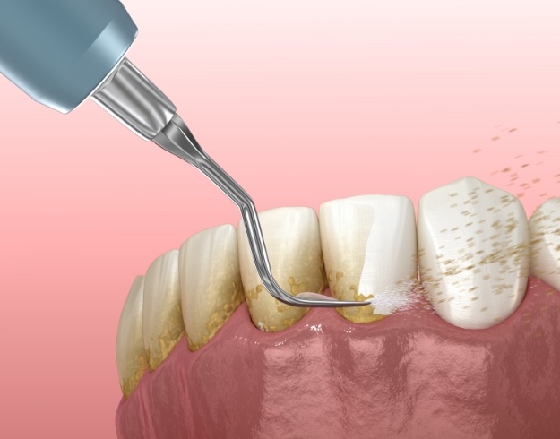 Illustration of scaling and root planing for gum disease treatment in Orlando