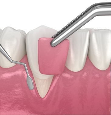 Illustration of gum graft to cover tooth root