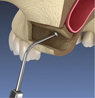 Illustration of sinus lift being performed