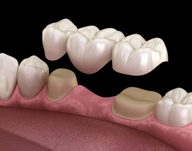 Illustration of dental bridge replacing missing teeth in Orlando