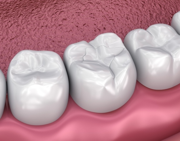 Illustration of teeth with dental sealants