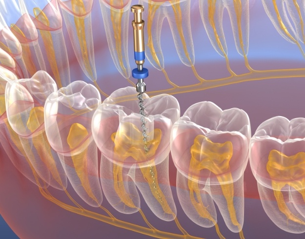 Illustration of tooth receiving root canal treatment in Orlando