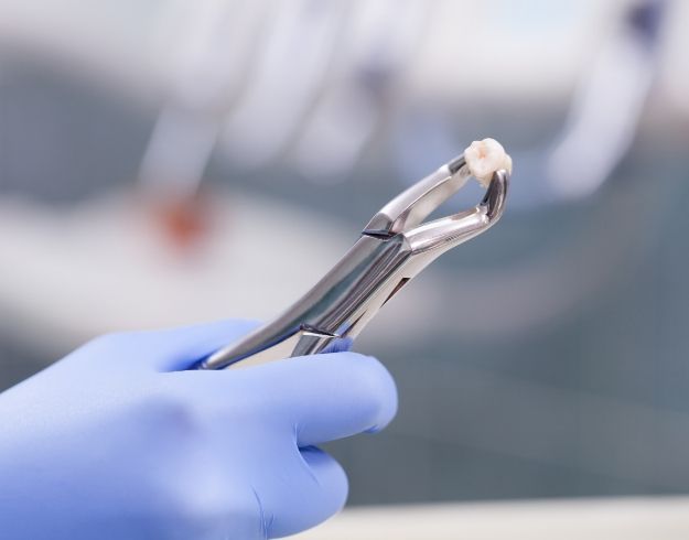 Gloved hand holding forceps with removed tooth